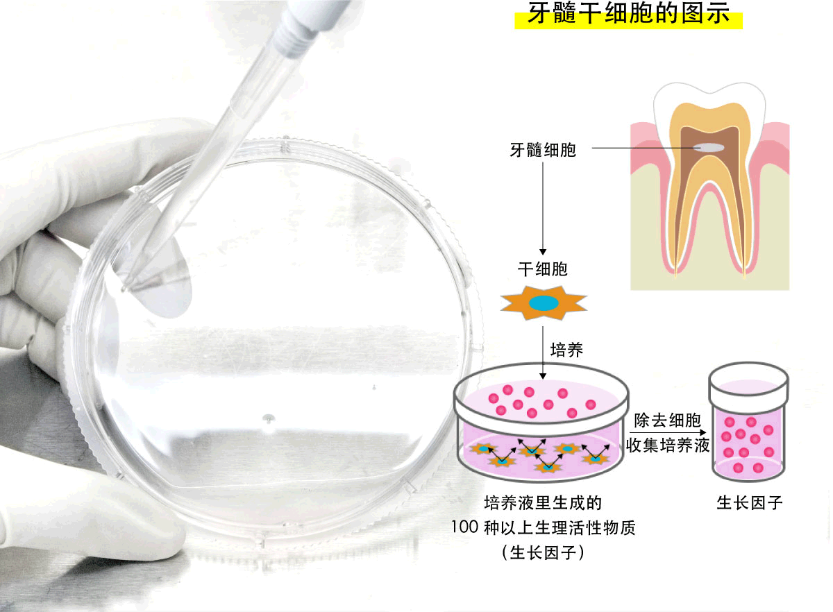 牙髓干细胞的「上清液治疗」